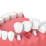 التركيبات الثابتة